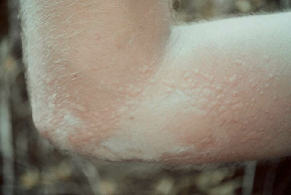 Sådan føles det at blive angrebet af en flok bier